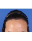 After Hair Transplant&nbsp;Hairline